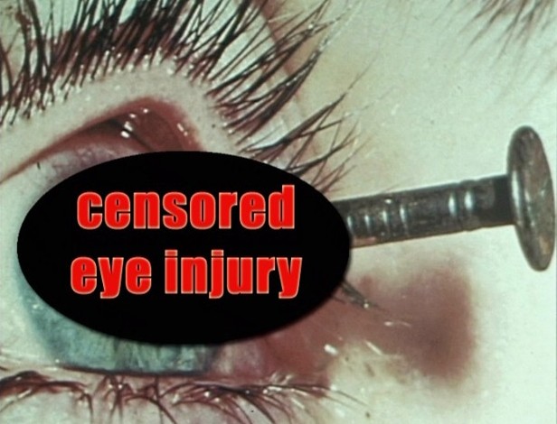 A censored eye injury that occurred because the victim did not follow their eye safety training